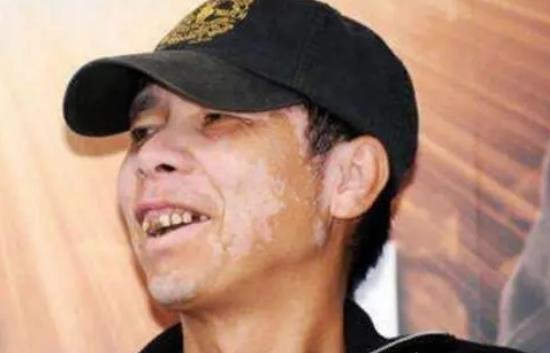 馮小剛得白癜風的原因