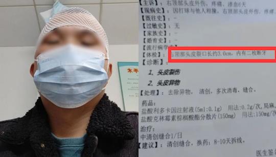 男子打球6天后頭皮里發(fā)現2顆牙，網友神評論