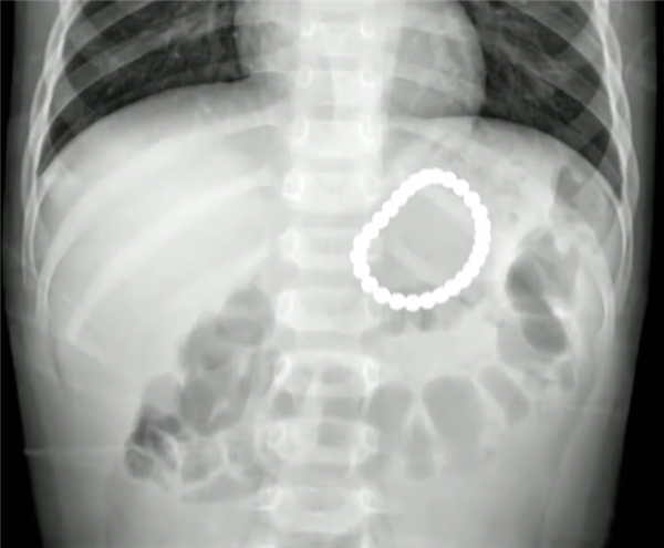 太危險了！2歲幼童誤吞28顆磁力珠-第1張圖片