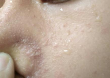 臉上起皮和白色