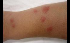 被蟑螂咬后會怎么樣?蟑螂咬人后的皮膚圖片