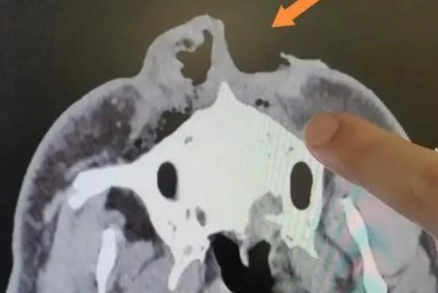 驚險！男子上山采菌被熊咬掉一半鼻子，怎么回事？