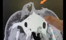 驚險(xiǎn)！男子上山采菌被熊咬掉一半鼻子，怎么回事？