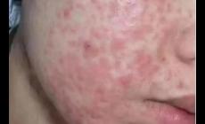 凍干粉會引起激素臉嗎 凍干粉會造成激素臉嗎