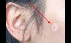 痣的周圍變白是為什么呢 痣的周圍變白是為什么呢