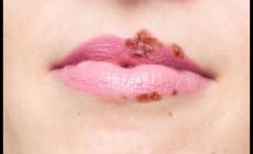 嘴角起黃膿性水泡怎么辦 嘴角起黃膿性水泡怎么辦啊